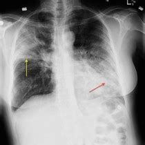 Aspiration pneumonia - Radiology at St. Vincent's University Hospital