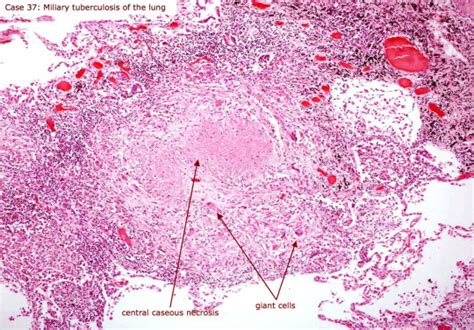 Pathologic Cell Injury and Cell Death II – Necrosis – The Art Of Medicine