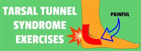 Tarsal Tunnel Syndrome Exercises Massages & Stretches [VIDEO GUIDE]