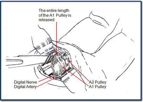 Sydney Hand Surgery » Trigger Finger