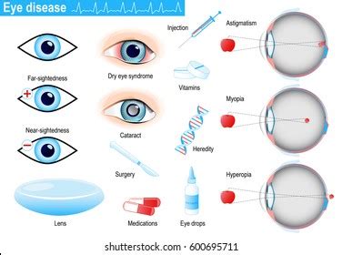 Human Eye Diseases Disorders Medical Infographic Stock Vector (Royalty ...