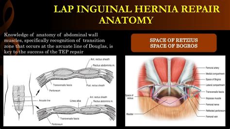 Lap inguinal hernia repair/ operative surgery