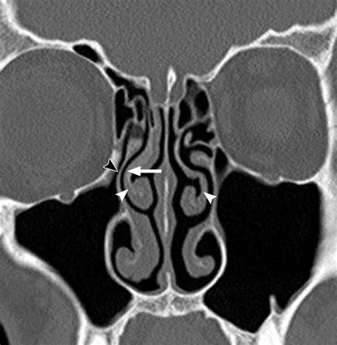 The Preoperative Sinus CT: Avoiding a “CLOSE” Call with Surgical Complications | Radiology