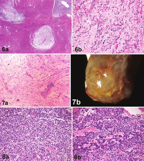 Myxoid leiomyosarcoma. a, The tumor has an infiltrative growth pattern... | Download Scientific ...