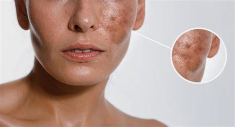 What Causes Hyperpigmentation?: Daphne Panagotacos, M.D., Inc.: Dermatology