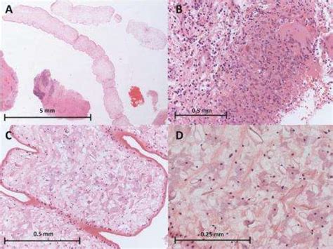 Brain-dwelling worm in UK man's head sequenced