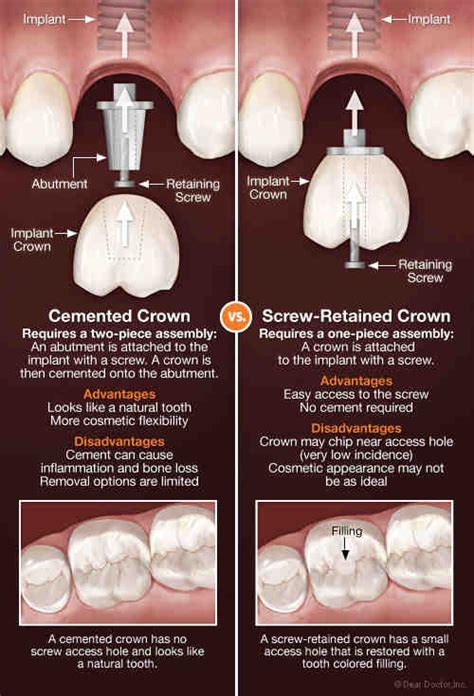 How to remove dental implant abutments - Dental News Network