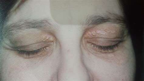 Eyelid Xanthelasma Archives - High Precision Dermatology Centre