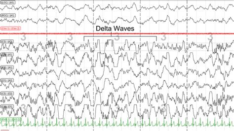 Hallmark of Stage N3 (slow-wave sleep or Stages 3 and 4 sleep: delta... | Download Scientific ...