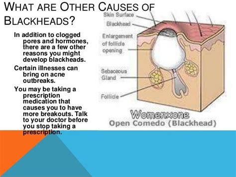 Common blackhead causes