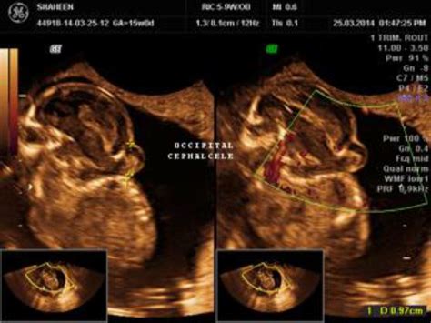 Antenatal ultrasound diagnosis of ‘Iniencephaly Apertus’ – ISGE