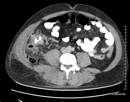 Liver Metastasis of Colon Cancer on CT | Download Scientific Diagram