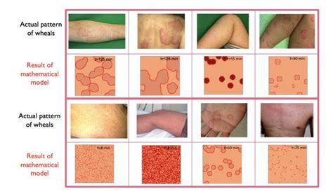 Studying the geometry of a common skin diseas | EurekAlert!