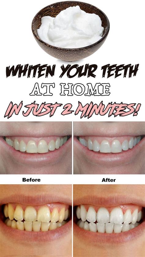 Whiten Your Teeth At Home In Just 2 Minutes! | Healthy Prize