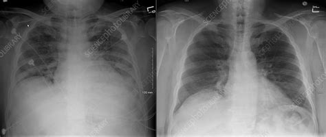 Walking pneumonia chest x ray findings - mashlopers