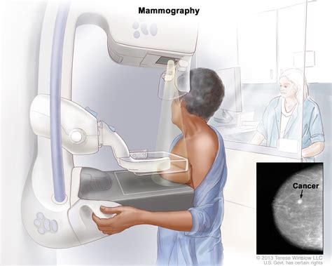 Mammography | ACS