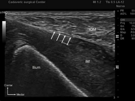 Ultrasound image of suprainguinal fascia iliaca block. IOM: internal... | Download Scientific ...