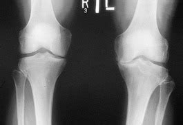 Diagnosis - Osteoarthritis