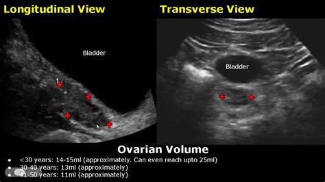 How To Measure Ovarian Volume Ultrasound | Ovary Length, Width, Depth Measurements TAS/TVS Views ...