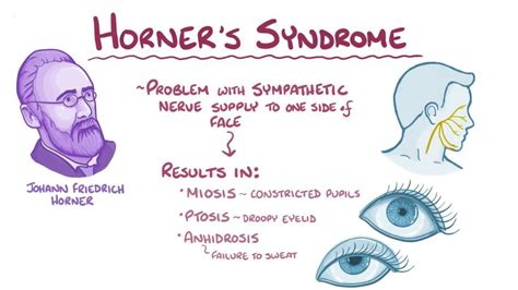 Horner Syndrome - Plastic surgery in Istanbul