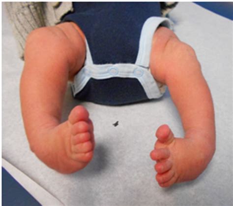 Club Foot(Congenital talipes equinovarus) - The Nepali Doctor