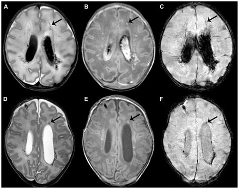 Punctate white matter lesions with a linear pattern. Early (A–C) and ...