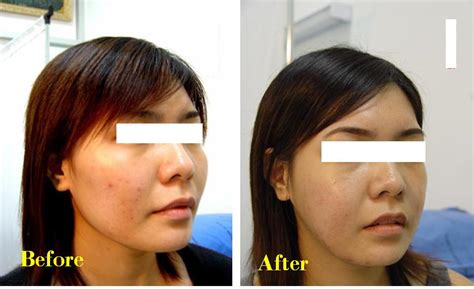 Plastic Surgery Photos: Cheek Bone Reduction Before And After Photos