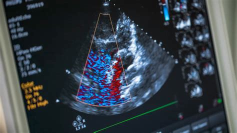 Echocardiogram: What Is It, Types, Preparation, and More