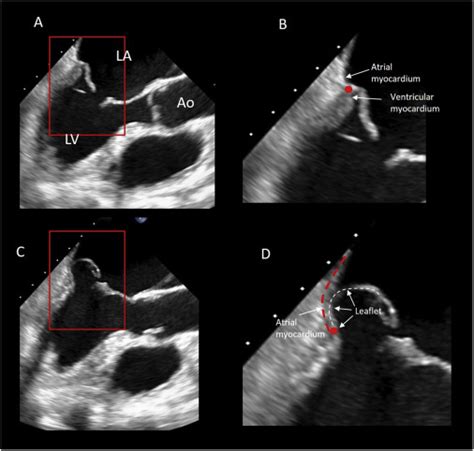 Morphology of Mitral Annular Disjunction in Mitral Valve Prolapse - Journal of the American ...