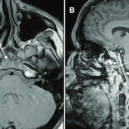 (A) Axial T1-weighted MRI demonstrates low T1 signal within the clivus... | Download Scientific ...