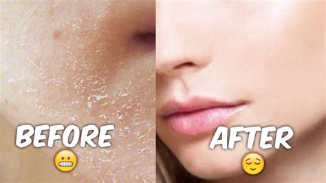 First Class Tips About How To Get Rid Of Flaky Skin - Loadexam