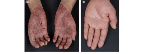 Palmar psoriasis before (a) and after (b) 3-month treatment with... | Download Scientific Diagram