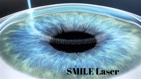 SMILE Laser Surgery | Causes | Symptoms | EyeMantra