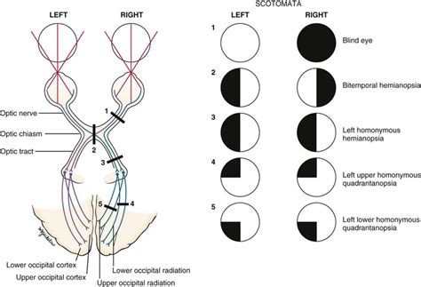 Quadrantanopia Definition And Causes