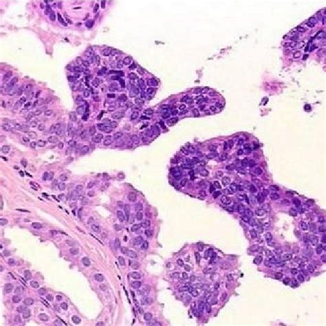 Fibrosarcoma. Anisocytosis, anisokaryosis, abnormal mitotic figures.... | Download Scientific ...