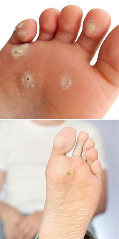 Diagnosis & Treatment of Plantar Warts (Verruca Plantaris)