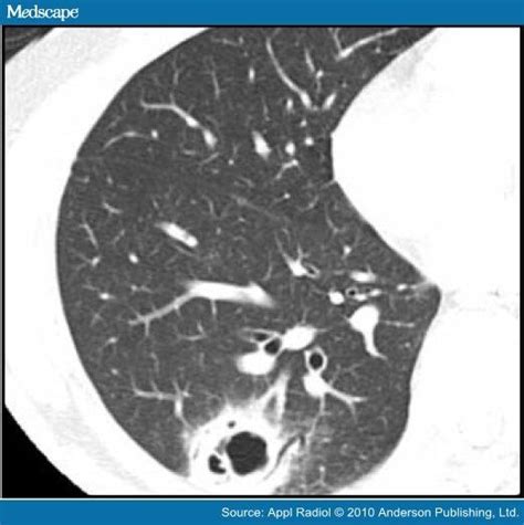 Cavities in the Lung in Oncology Patients: Imaging Overview