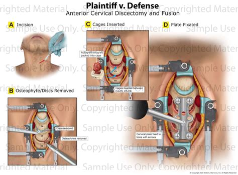 Anterior Cervical Discectomy (ACDF) Surgery: All You Need, 44% OFF