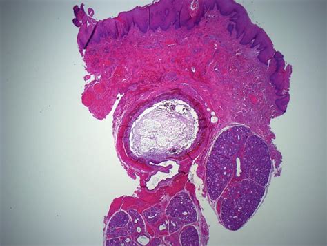 Mucocele Histology