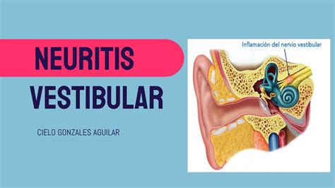 NEURITIS VESTIBULAR | CIELO ALEJANDRA GONZALES AGUILAR | uDocz