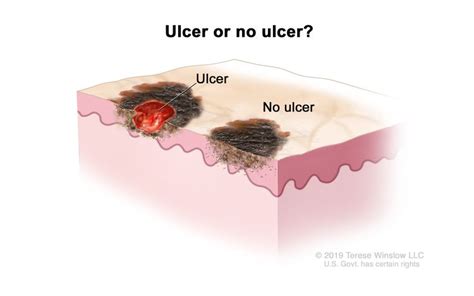 Melanoma Treatment (PDQ®)–Patient Version - Siteman Cancer Center