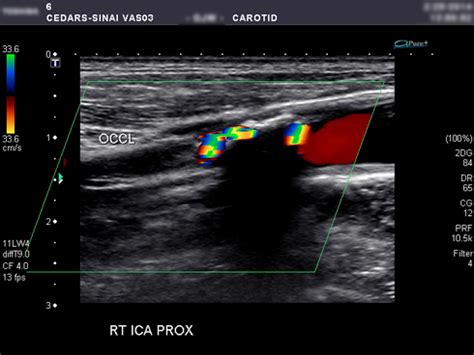 Carotid Duplex Ultrasound | Cedars-Sinai