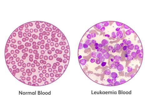 Leukemia Red Blood Cells