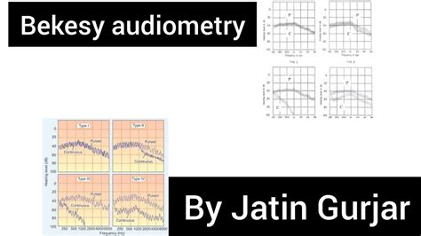 BEKESY audiometry , differential diagnosis of cp and rcp by bekesy ...