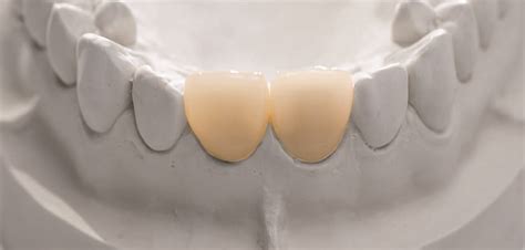 Z Crown Anterior | Bayshore Dental Studio