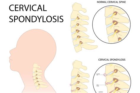 Cervical Spondylosis- Symptoms, Causes & Treatments Available