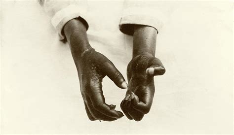 Hands Disfigured By Leprosy Photograph by American Philosophical Society