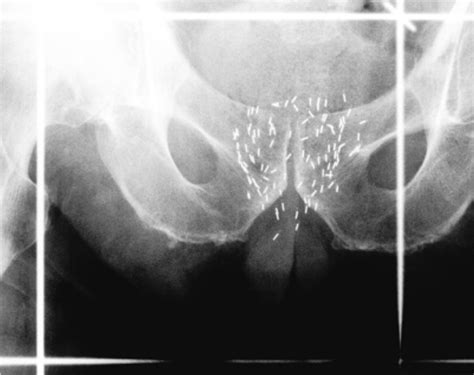 Systematic overview of the evidence for brachytherapy in clinically ...