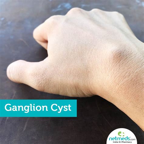 Ganglion Cyst – Causes, Symptoms and Treatment