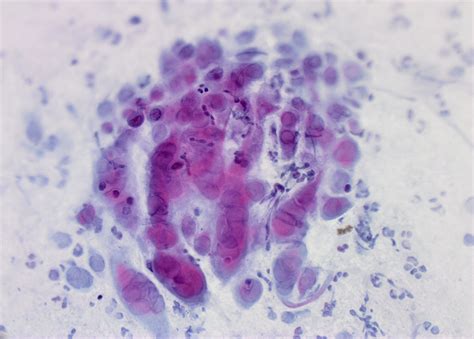 Herpes simplex virus (HSV) | MyPathologyReport.ca